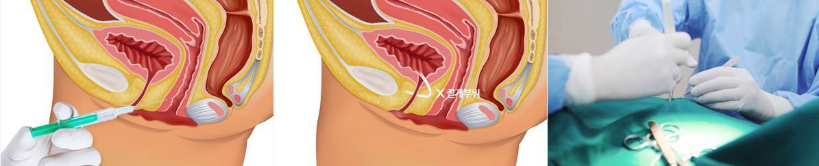 B-4 Urinary Incontinence Vaginoplasty image 8
