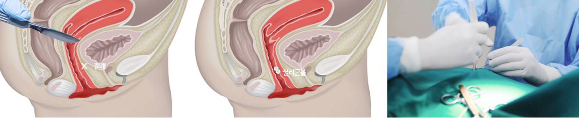 B-5 Extra(stem cell vaginoplasty, G-spot, Implant, PRP, L1) image 15