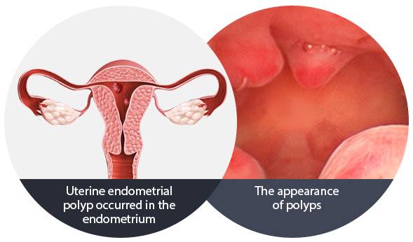 E-3 Endometrial polyp image 2