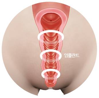B-5 Extra(stem cell vaginoplasty, G-spot, Implant, PRP, L1) image 19