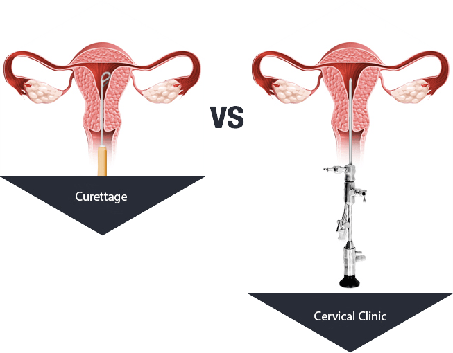 E-3 Endometrial polyp image 6