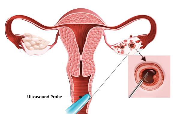 F-2 Endometrioma image 4